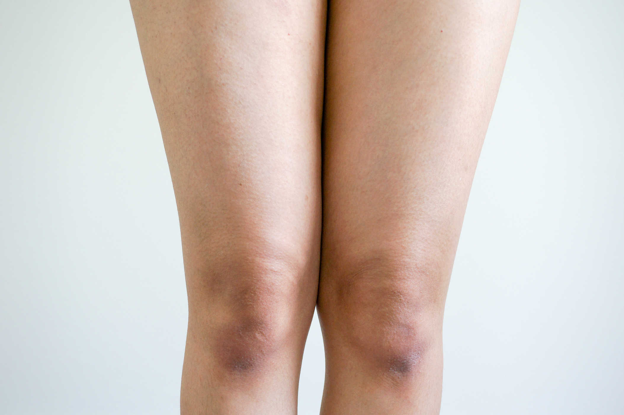 Mencerahkan Lutut Dengan Bahan – Bahan Alami yang Mudah Ditemukan? Yuk Cek Berikut Ini